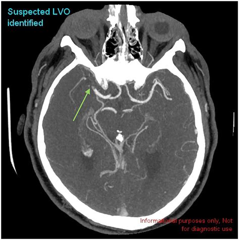 lvo medical term.